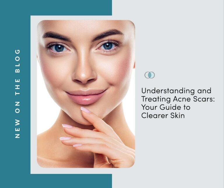 Understanding And Treating Acne Scars Your Guide To Clearer Skin