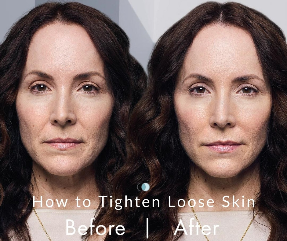 How to Tighten Loose Skin | Palo Alto Laser & Skin Care