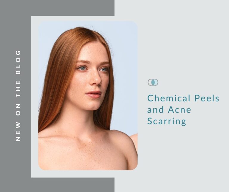 Chemical Peels and Acne Scarring Palo Alto Laser & Skin Care