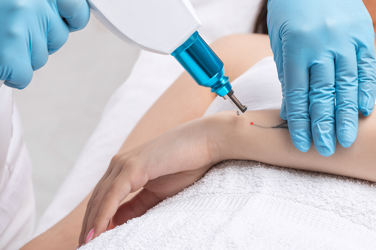 Person getting tattoo removal in Palo Alto